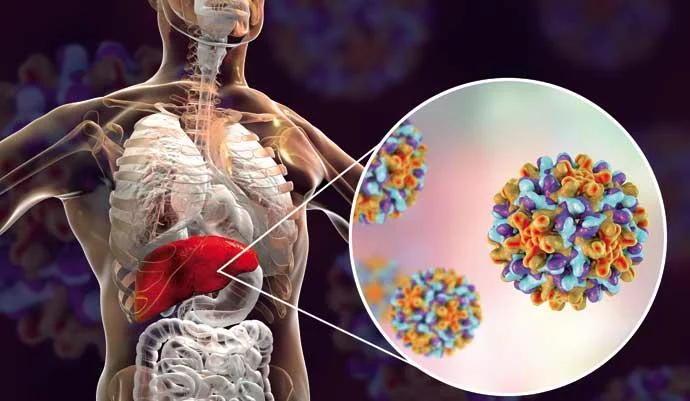 Hepatitis inflamación del hígado que puede ser producida por diferentes factores que causan enfermedades hepáticas graves y cáncer de hígado. Hepatitis inflamación del hígado que puede ser producida por diferentes factores que causan enfermedades hepáticas graves y cáncer de hígado.