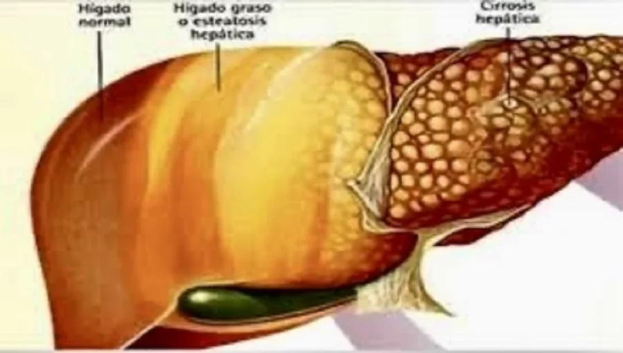 Hígado graso Hígado graso