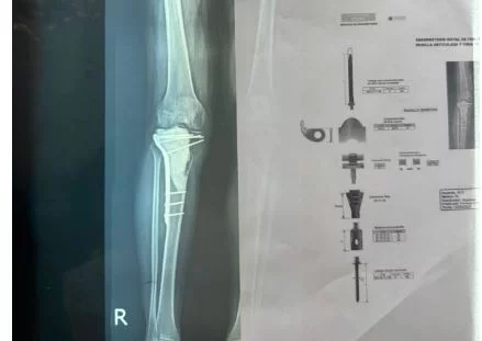 Placa de tumor óseo
