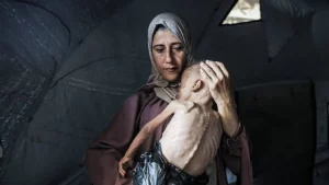 Niño con desnutrición en Gaza
