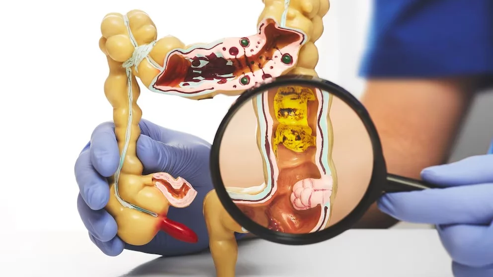 Investigaciones de Harvard vinculan el yogur con menor riesgo de cáncer colorrectal y mejor salud intestinal