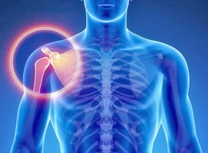 sarcoma -salud