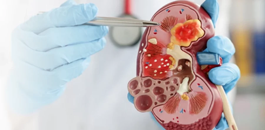 Enfermedad renal diabética Enfermedad renal diabética