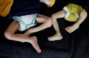 Desnutrición en niños