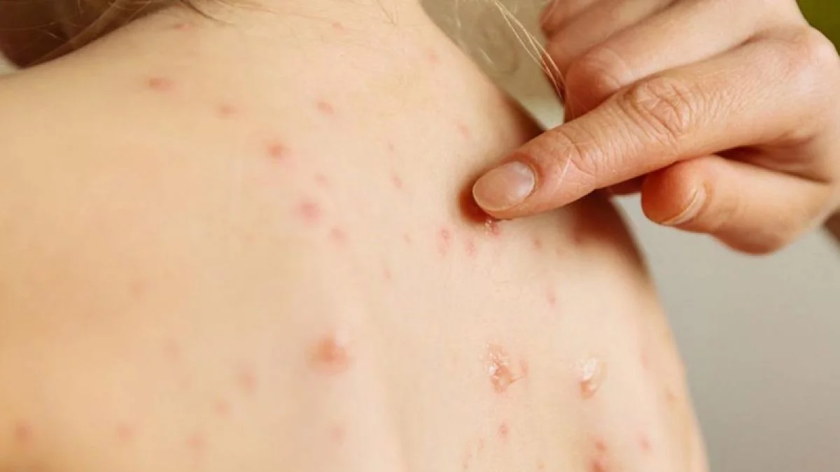 Paraguay confirma primer caso de sarampión en una década tras eliminación del virus en 2015