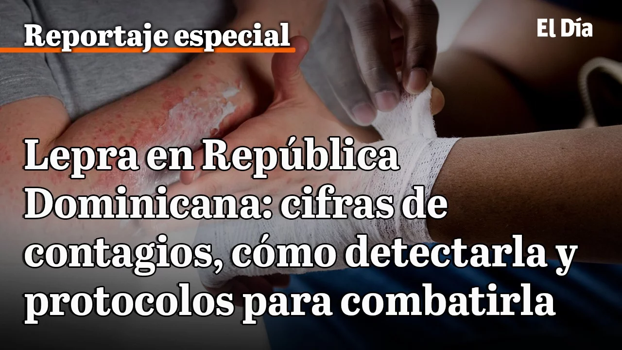 La lepra persiste en República Dominicana con 36 casos detectados en 2025
