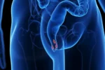 1800x1200_getty_rf_hemorrhoids_illustration_other