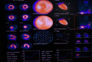 Es  para la detección temprana de enfermedad coronaria.