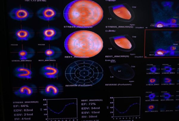 Es  para la detección temprana de enfermedad coronaria.