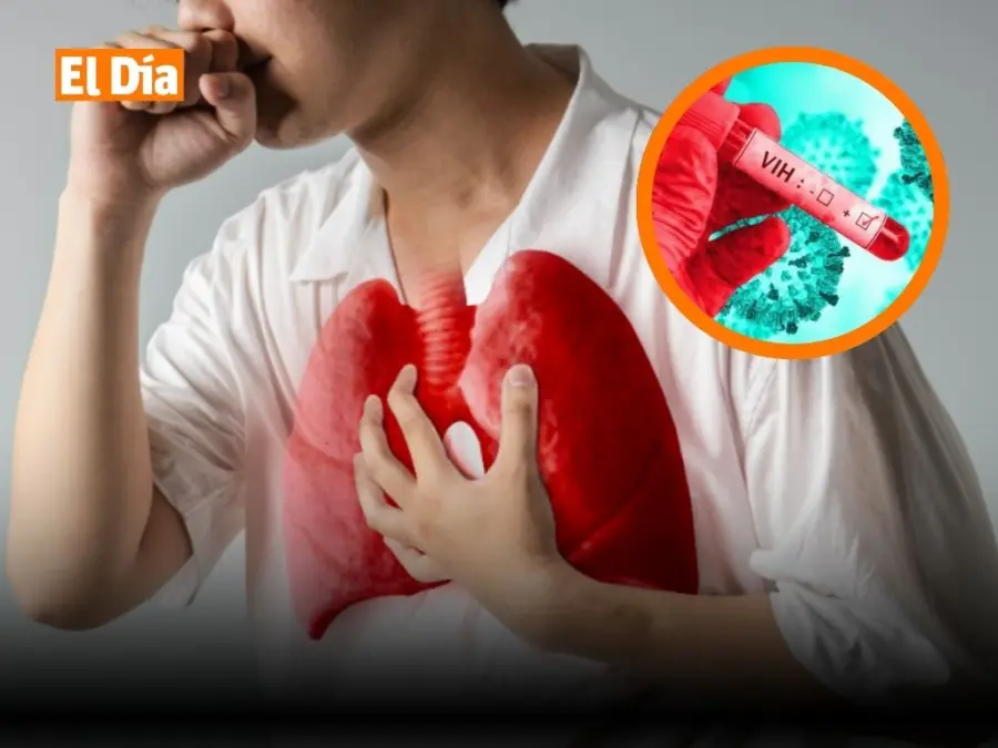 Tuberculosis-VIH