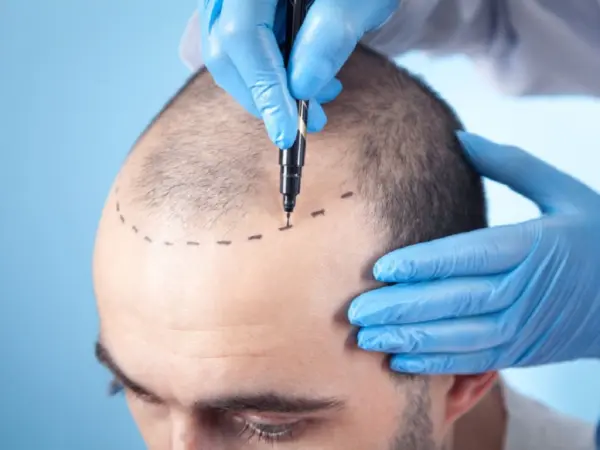Pelo-hombre