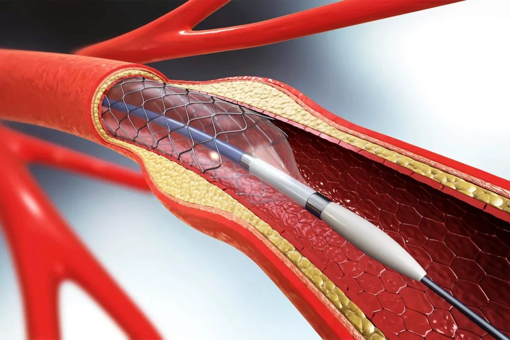 stents-salud 