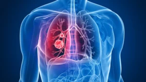 Cáncer de pulmón podría ser tratado con nuevo fármaco.