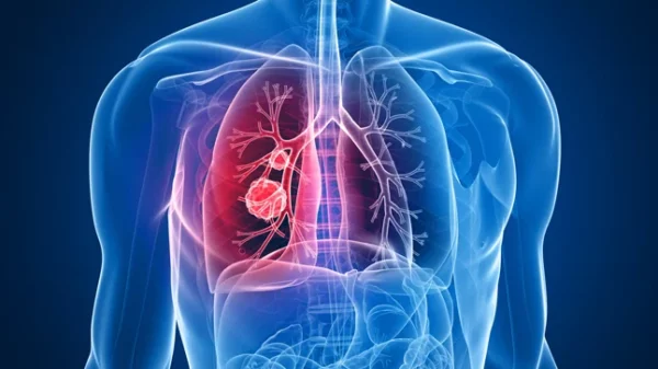 Cáncer de pulmón podría ser tratado con nuevo fármaco.