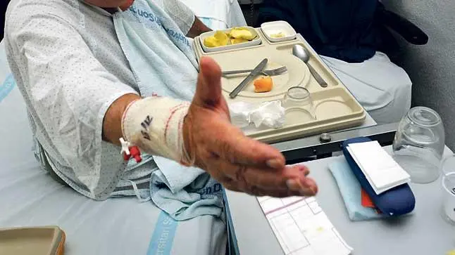desnutricion-pacientes-cronicos