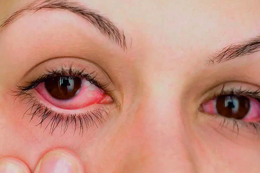 Ojos rojos
