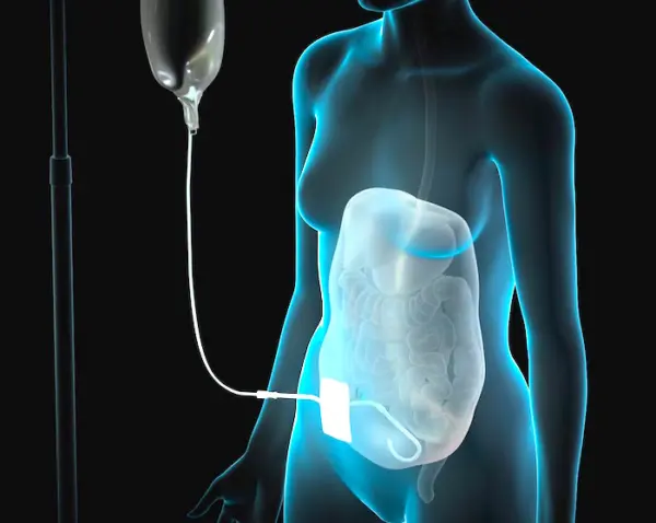 alimentacion peritoneal