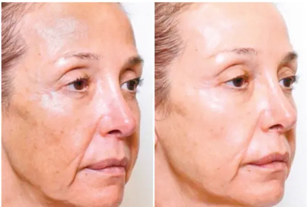 El tratamiento potencia los resultados de otros procedimientos dermatológicos.