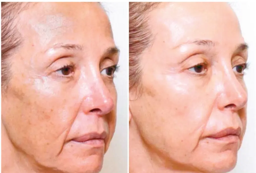 El tratamiento potencia los resultados de otros procedimientos dermatológicos.