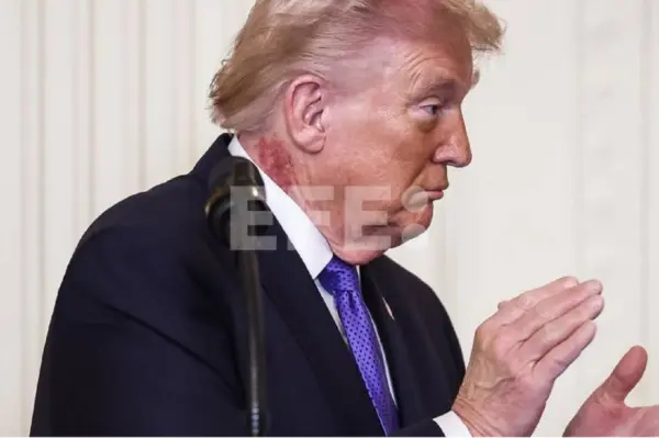 trump zarpullido