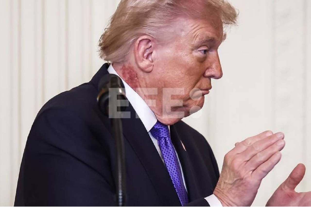 Trump luce un sarpullido en el cuello, que su médico atribuye a un tratamiento preventivo