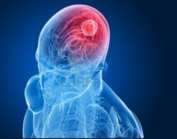 Estos  tumores  se originan en estructuras como la cavidad oral (lengua, encías y paladar).