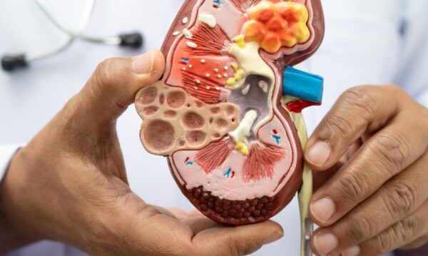 Kidney disease, Chronic kidney disease ckd, Doctor hold human mo