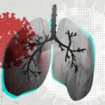 La detección a tiempo de la tuberculosis reduce su impacto