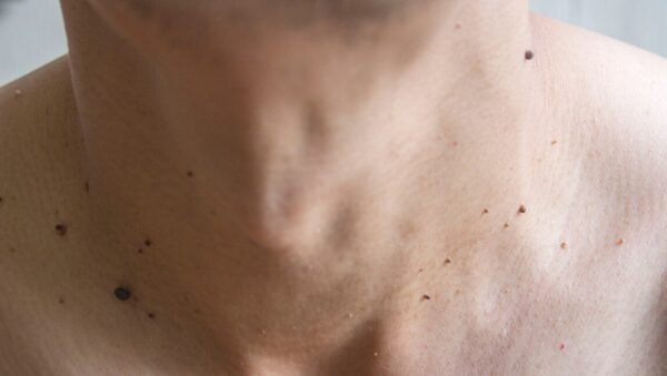 En la mayoría de los casos no representan un riesgo para la salud, pero pueden aumentar en número con el tiempo.