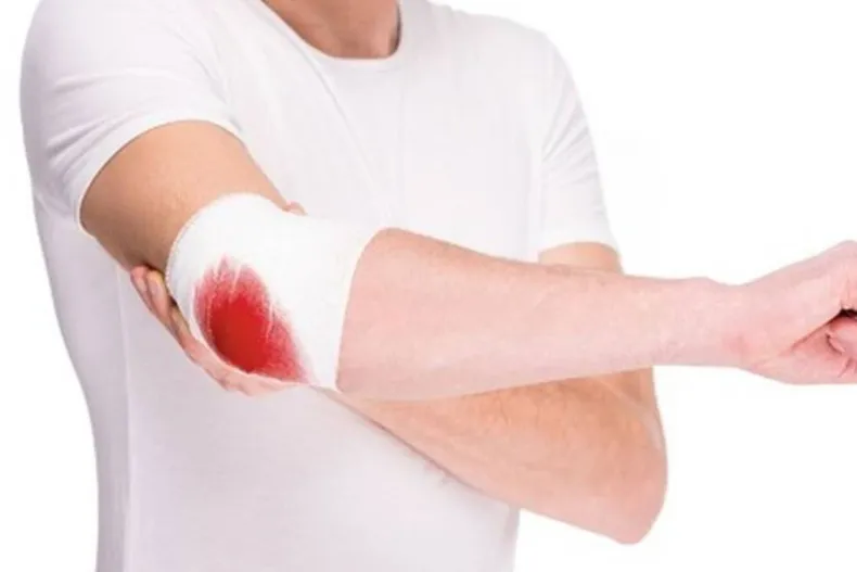 Hoy Día Mundial de Hemofilia: 3 de cada que la padecen no lo saben