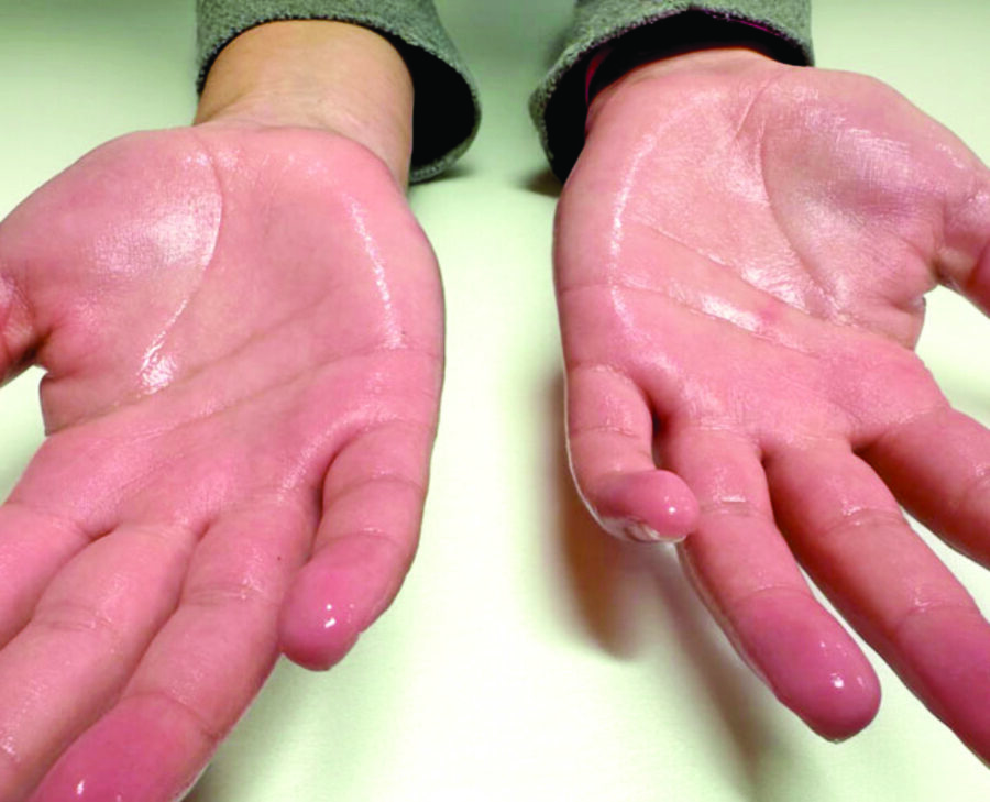 Expertos dicen  que la toxina botulínica puede reducir significativamente los síntomas.