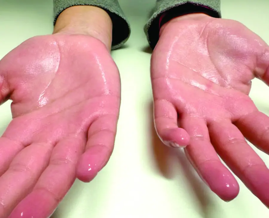 Expertos dicen  que la toxina botulínica puede reducir significativamente los síntomas.