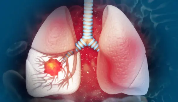 Cáncer de pulmón