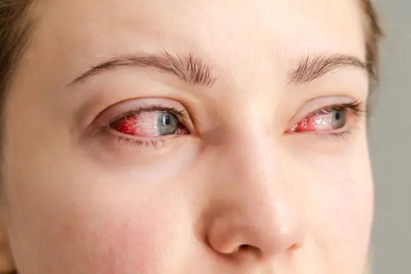 Director del Incocegla, Tomás Vargas, dijo que la presencia del polvo del Sahara incrementa los casos de irritación ocular, conjuntivitis y otras alergias.