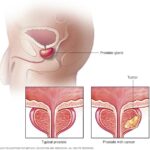 Nueva prueba busca distinguir los cánceres de próstata que realmente requieren tratamiento