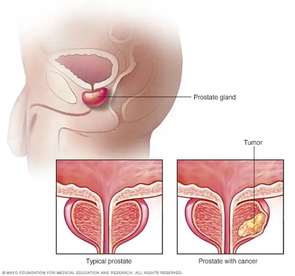 Cáncer de próstata