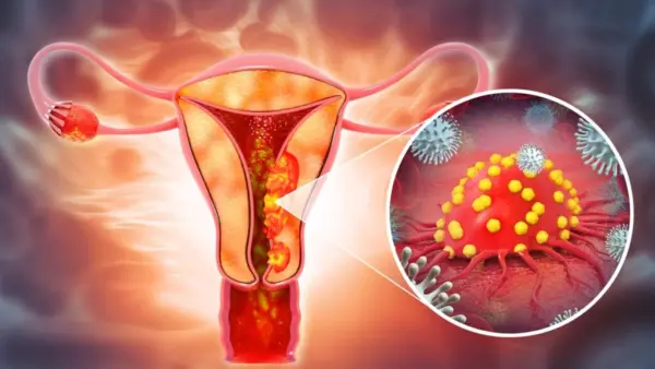 cancer-de-ovario-182524-1024×576