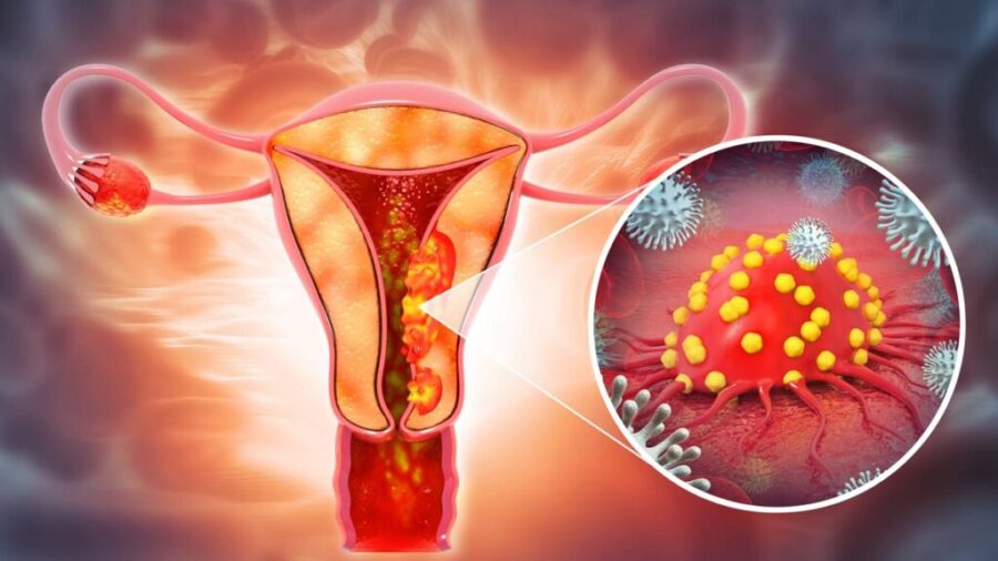 cancer-de-ovario-182524-1024×576
