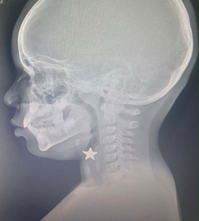 Niño de 8 años tenía un objeto en forma de estrella, que obstruía sus vías aéreas.