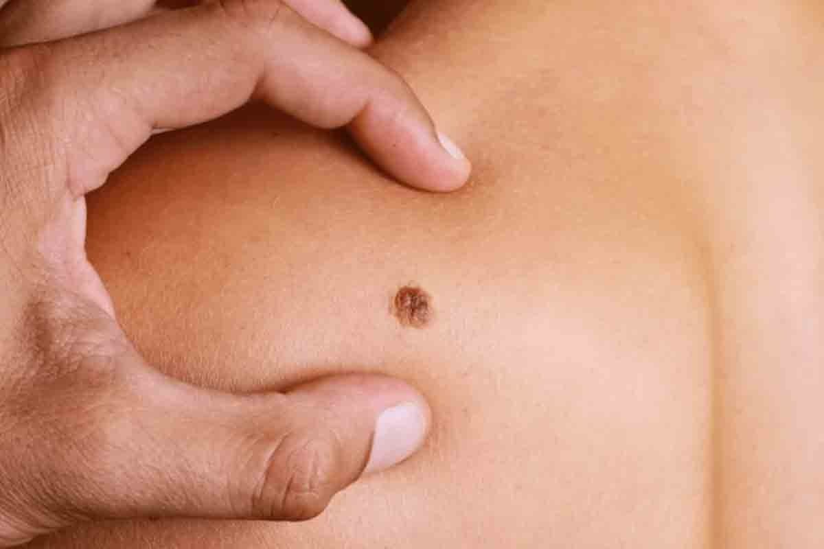 Ministro de Salud advierte sobre la importancia de detectar a tiempo el sarcoma, un cáncer poco frecuente pero de alto riesgo