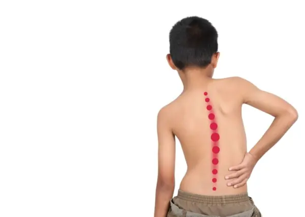 Niño con escoliosis