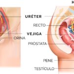 ¿Cómo afecta la calidad de vida en el paciente con estrechez uretral?