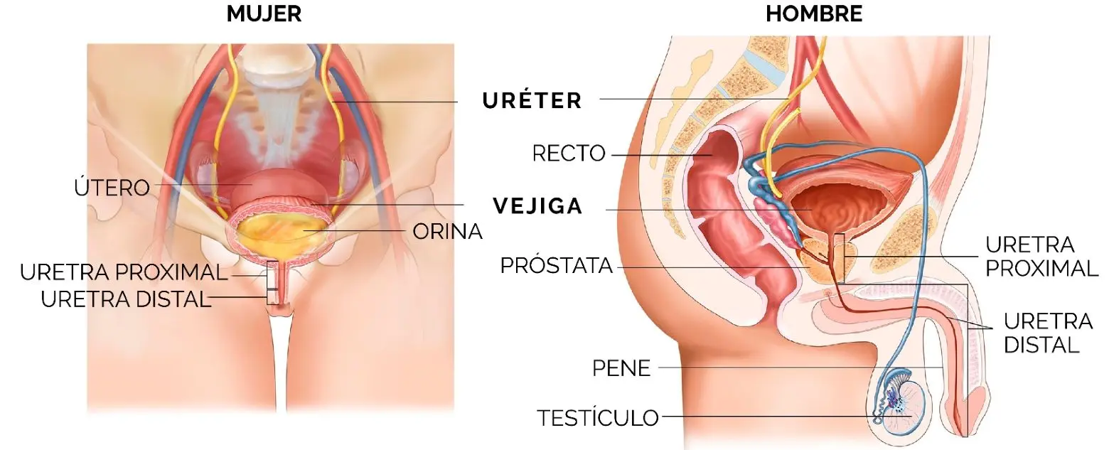 ¿Cómo afecta la calidad de vida en el paciente con estrechez uretral?