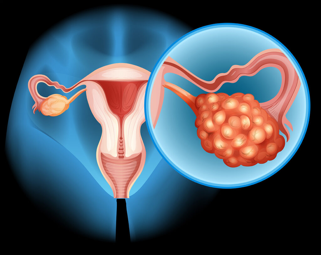 Tecnologías de alta precisión amplían opciones frente al cáncer urológico
