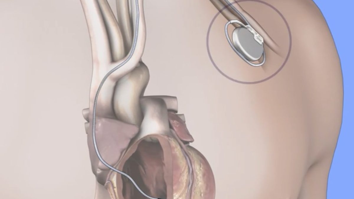 Sociedad Dominicana de Cardiología avala uso de desfibriladores implantables para prevenir muerte súbita en pacientes de alto riesgo