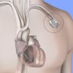 Cardiólogos respaldan uso de desfibrilador implantable para prevenir la muerte súbita