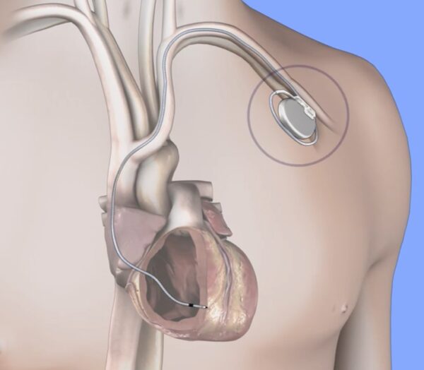 Cardiólogos respaldan uso de desfibrilador implantable para prevenir la muerte súbita
