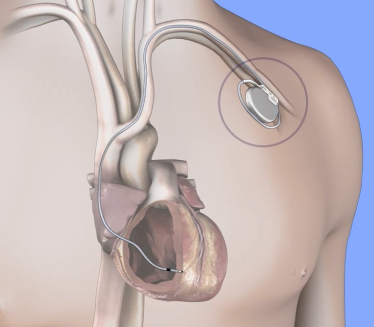 Cardiólogos respaldan uso de desfibrilador implantable para prevenir la muerte súbita