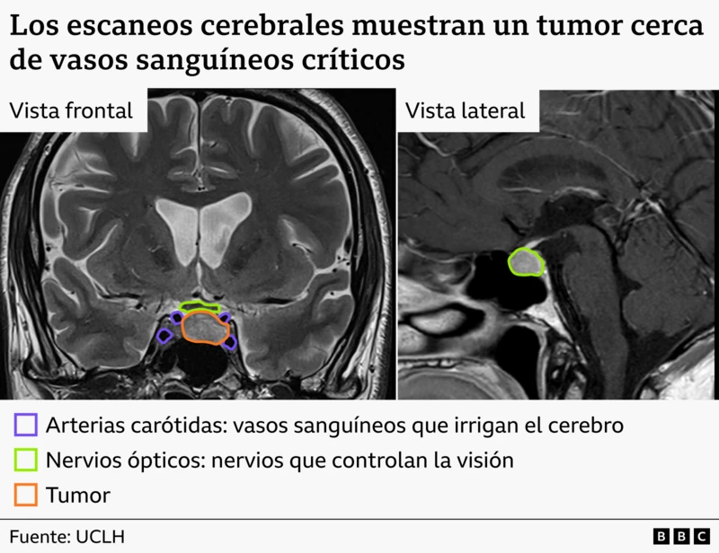 El primer paciente del mundo al que le retiraron un tumor en el cerebro con ayuda de la IA