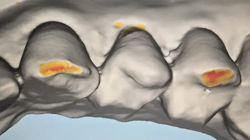 Algunos dentistas afirman que cada vez más jóvenes rechinan los dientes. ¿Eres uno de ellos?